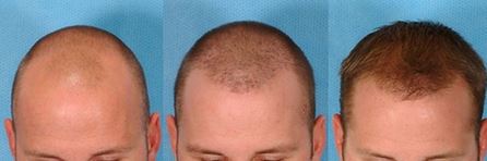 Cuáles son los síntomas de alopecia